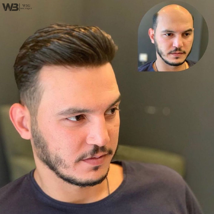 Hair Density Correction Services