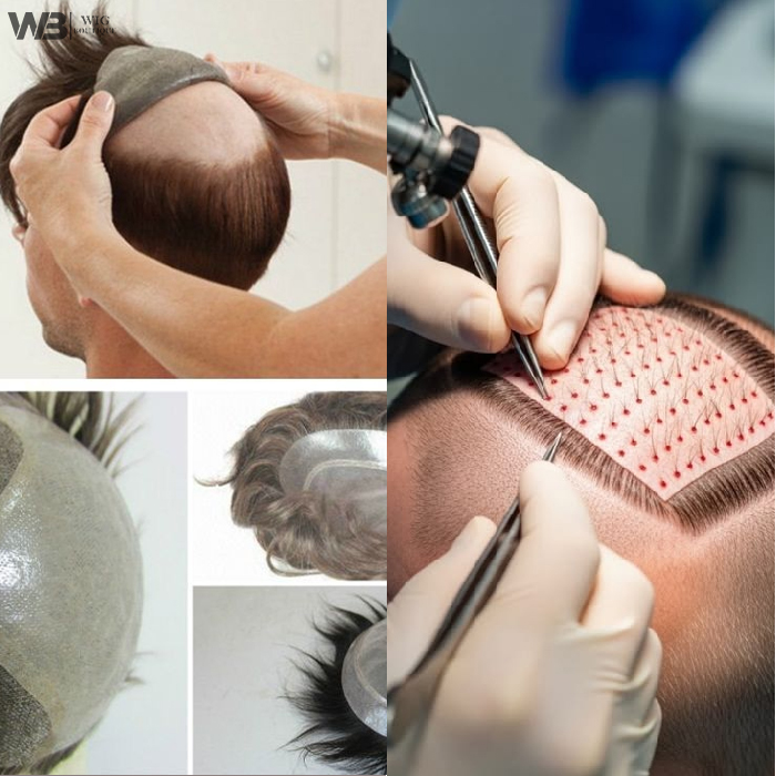 Hair Patch vs Hair Transplant Comparison