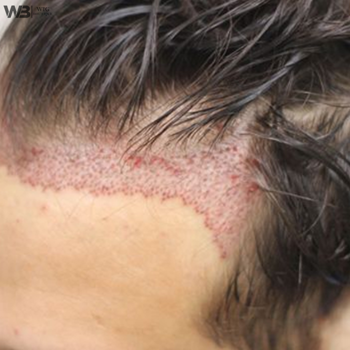 Professional hairline design creating natural-looking hairlines for hair systems