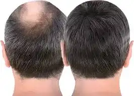 Premium human hair wigs and patches for natural hair replacement