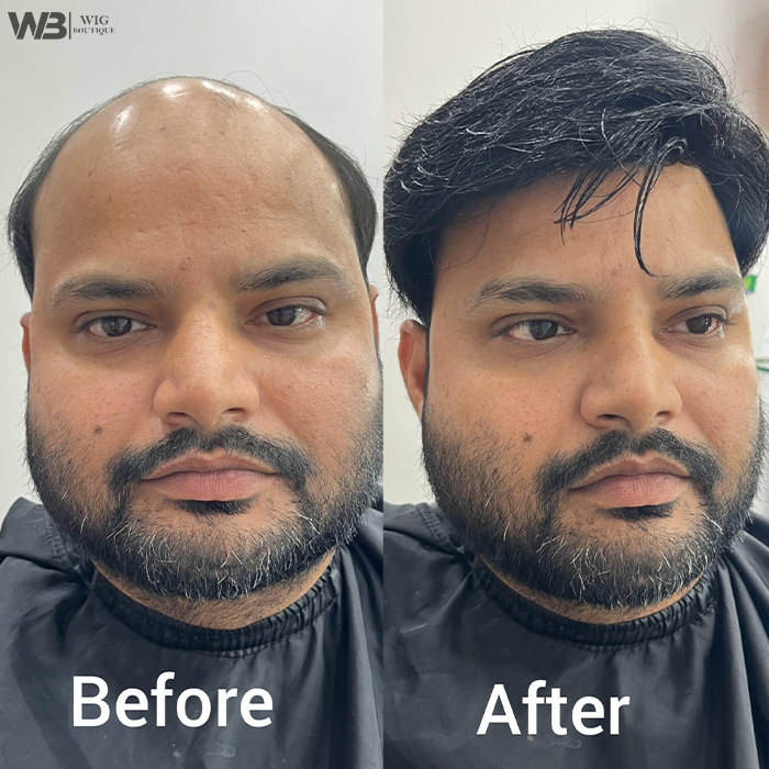Best hair patch services in Rohini Delhi