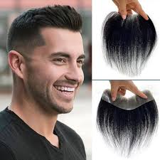 Hair Patch in Delhi - Cost, Benefits & Solutions