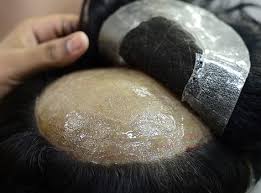 Non-Surgical Hair Replacement Solutions