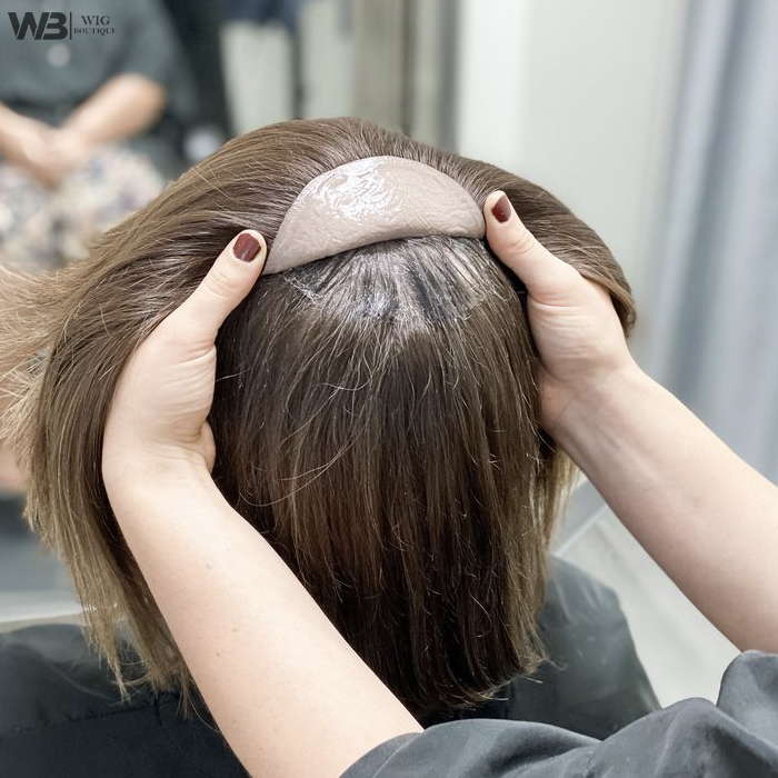 Hair Loss Treatment