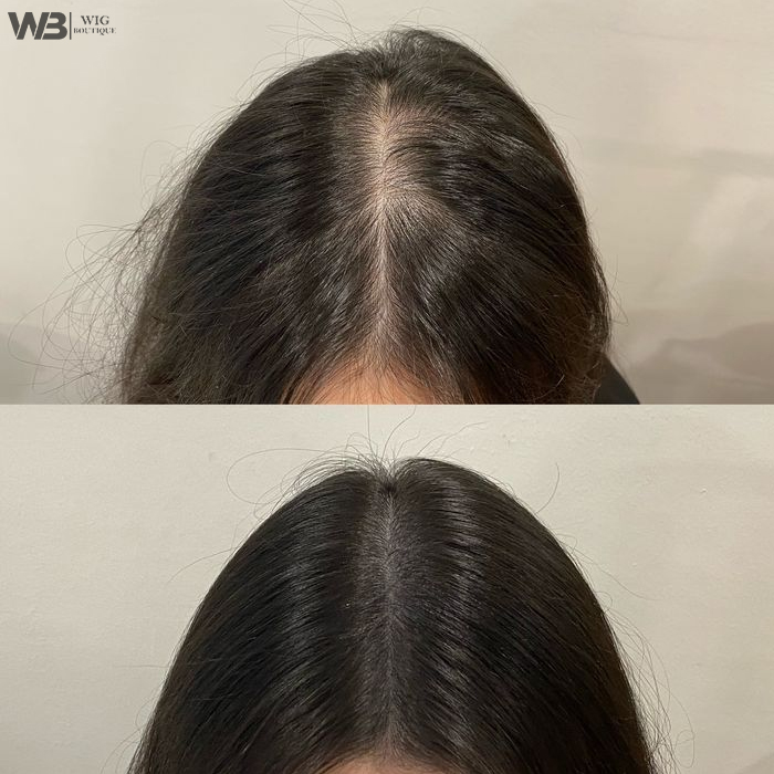 Hair Loss Treatment