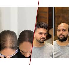 Hair Taping vs Hair Bonding