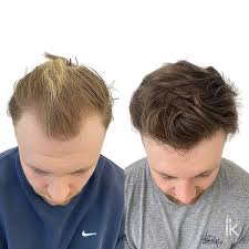 Hair Replacement in Rohini